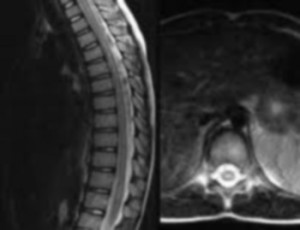 Transverse myelitis